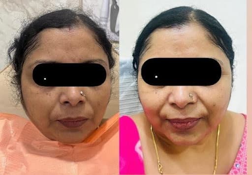 Before and after chemical peel treatment result