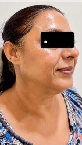 Before and after microneedling and GFC treatment result